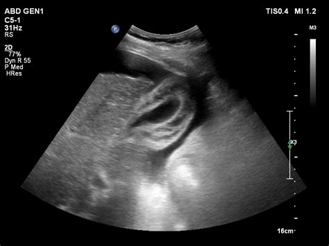 gallbladder wall thickness 4mm treatment